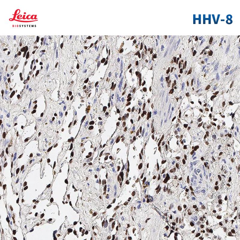 人疱疹病毒8型（HHV-8）抗体试剂