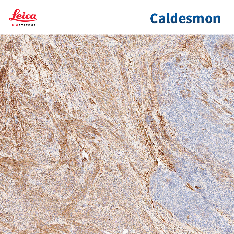 钙调素结合蛋白（Caldesmon）抗体试剂（免疫组织化学法）